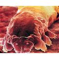 Hajhullást okozó Demodex atka: Béky László beszélgetése Dr. Sólyom Katalinnal